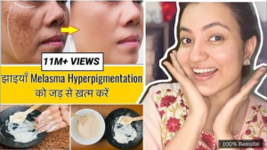 Read more about the article How to Treat Hyperpigmentation – Reasons, Symptoms and Treatment