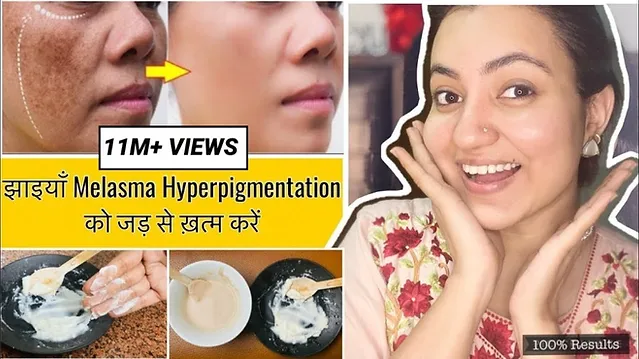You are currently viewing How to Treat Hyperpigmentation – Reasons, Symptoms and Treatment