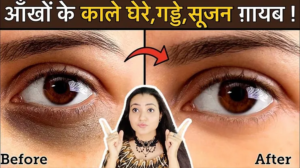 Read more about the article Cure Dark Circles, Puffy and Sunken Eyes Naturally: 100% Natural Remedy by Preity Prerna