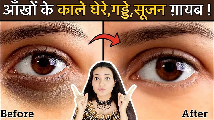 You are currently viewing Cure Dark Circles, Puffy and Sunken Eyes Naturally: 100% Natural Remedy by Preity Prerna