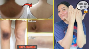 Read more about the article Lighten Knees and Elbows Naturally: Best Natural Remedy for Dark Knees and Elbows